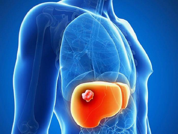 Cancro al Fegato: fattori di rischio