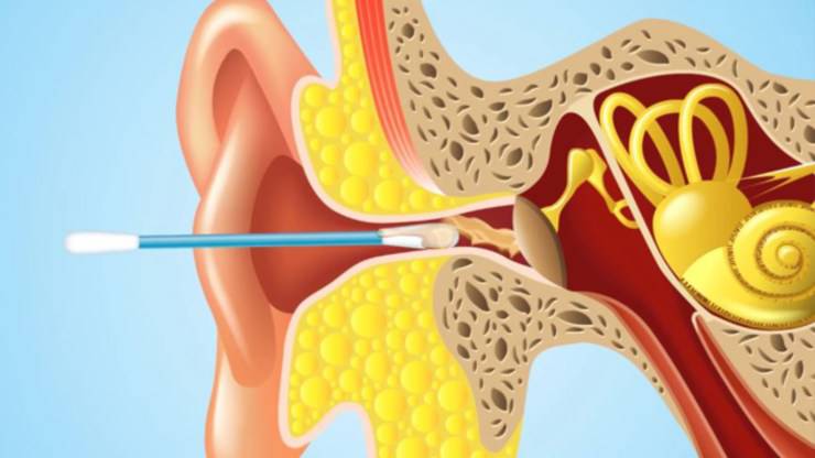 Tappo di cerume - Ecco come eliminarlo 