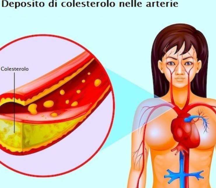 Colesterolo Ldl e malattie cardiovascolari 