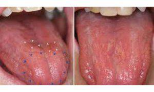 carenza vitamine lingua