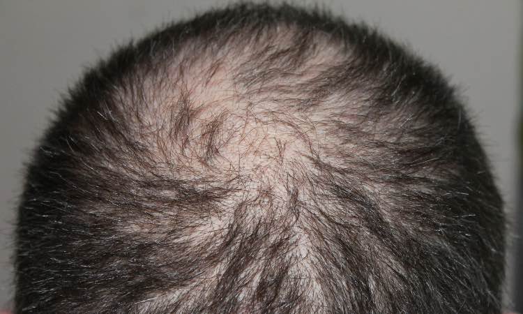 Perdita di capelli o alopecia, cause e il ruolo dell'alimentazione