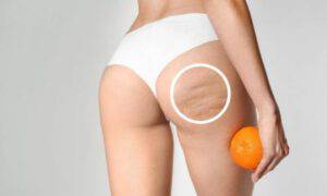 cellulite camminare