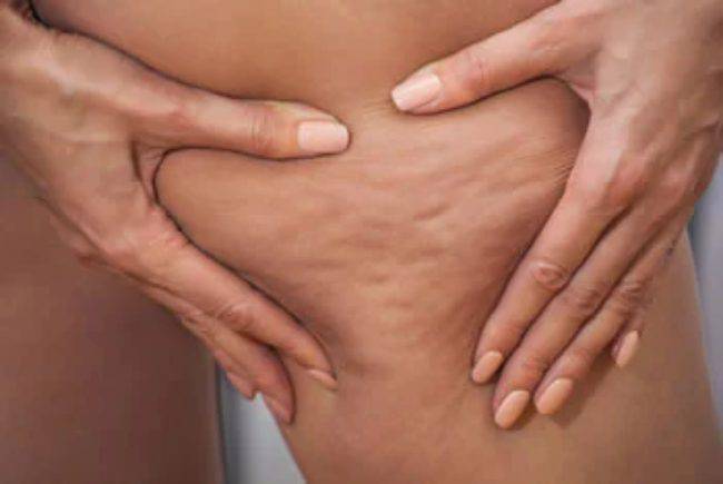 Perdere peso e diminuire la cellulite: ecco come fare