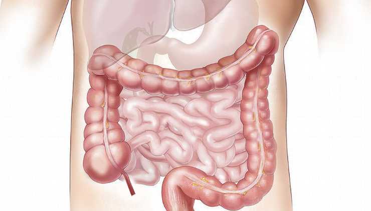 Colon irritabile