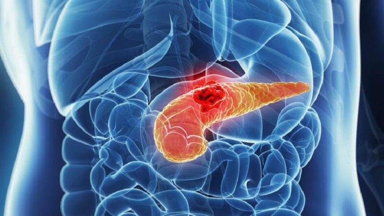 Cancro al pancreas (Igea Sant Antimo)