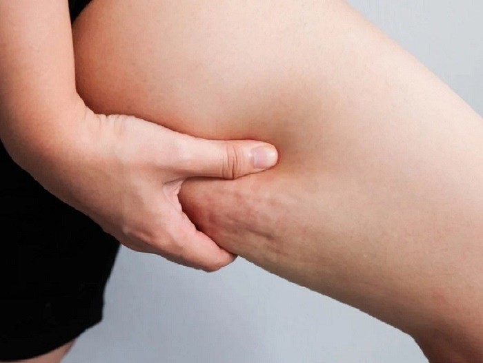 Cellulite: cercate di evitare questi alimenti