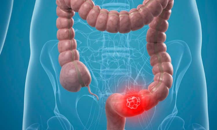 Cancro al colon: non sottovalutare mai questi sintomi 8 Cancro colon sintomi
